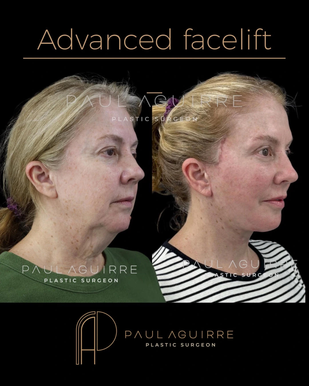 Antes y después de Deep Plane Facelift — paciente del Dr. Paul Aguirre, Bogotá