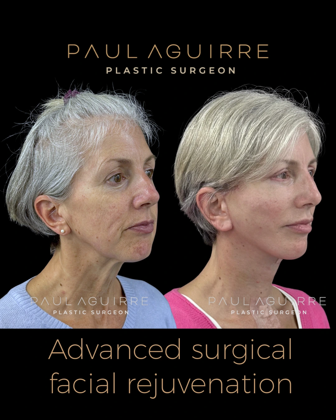 Resultado de Deep Plane Facelift — paciente del Dr. Paul Aguirre, Bogotá